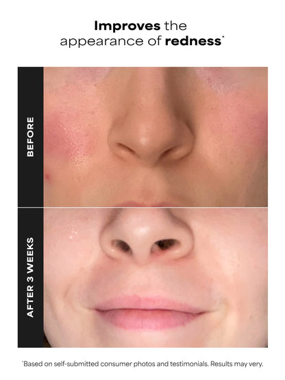 10% Azelaic Acid Booster