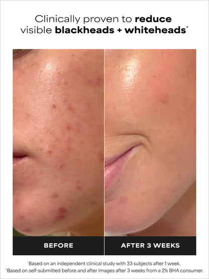 2% BHA Exfoliating Toner Duo